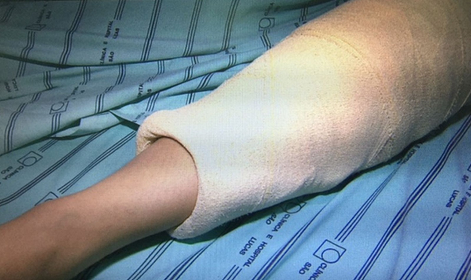 Vítima de queda precisou operar o joelho esquerdo (Foto: TV Sergipe)