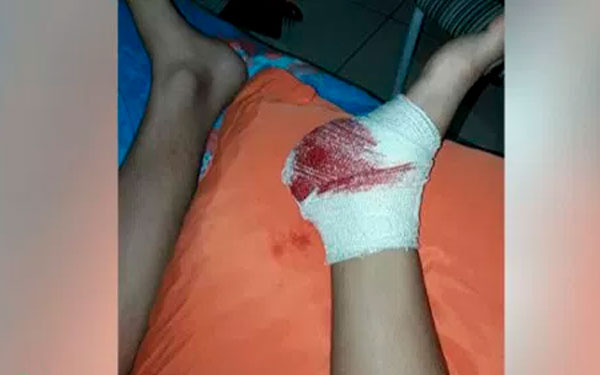 Menina de 12 anos é atingida por bala perdida em Lagarto