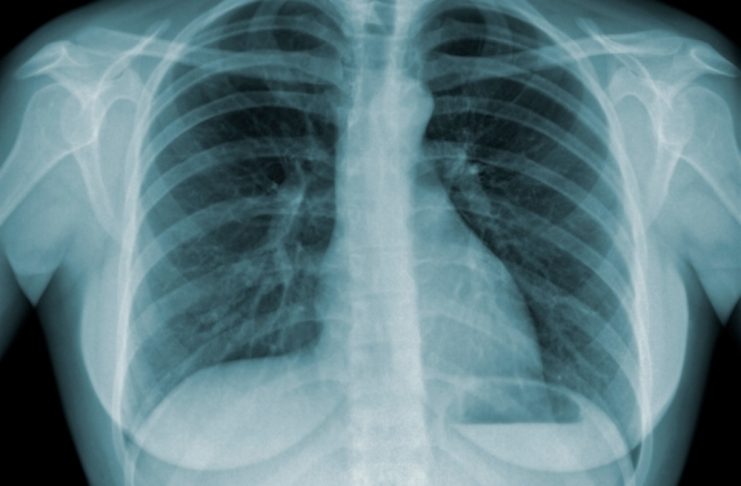 tuberculose
