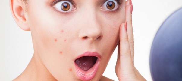 6 hábitos que pioram a acne facial