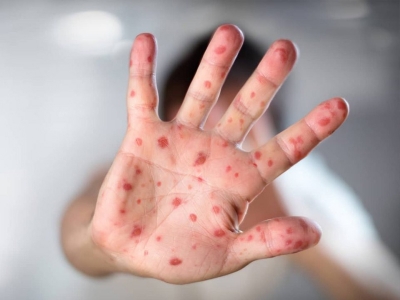 Secretaria de Saúde de Lagarto faz alerta sobre a síndrome mão-pé-boca, mais comum em crianças