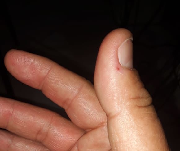 Além das coceiras, a alergia causou inchaço nas mãos do paciente