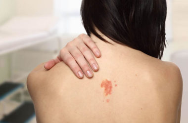 Dezembro Laranja alerta para prevenção do câncer de pele
