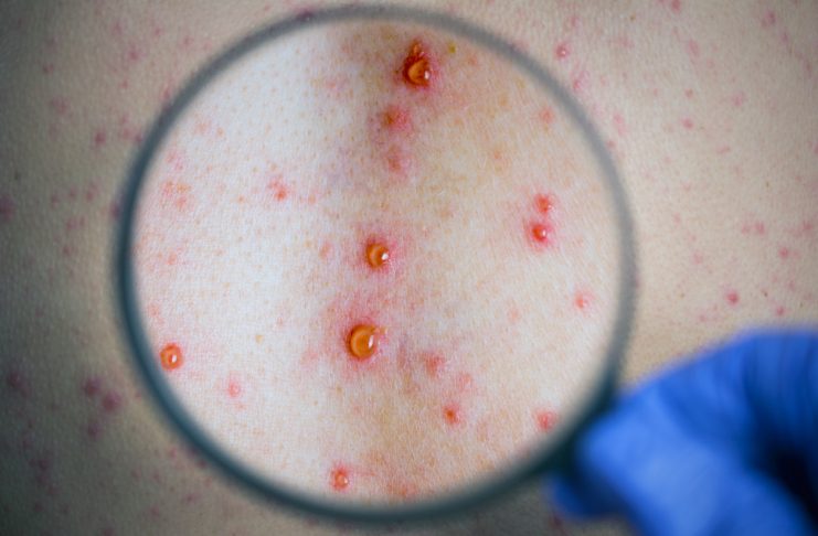 epidemic Varicella viral infection concept. skin bubble rash