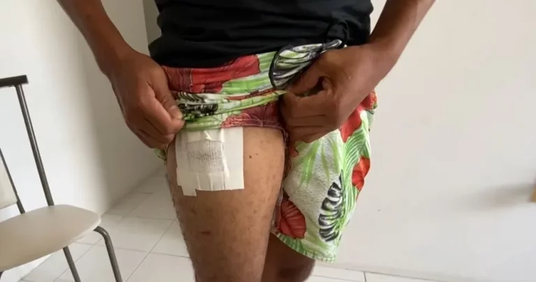 Homem fica ferido após celular explodir em bolso no interior de SE