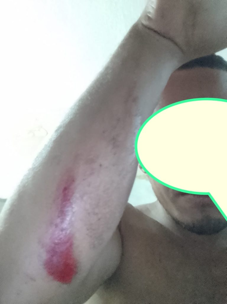 Animal solto na pista deixa motociclista ferido em Lagarto
