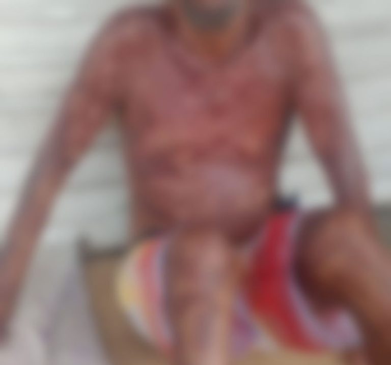 Homem em situação de rua morre após ter 35% do corpo queimado em Aracaju