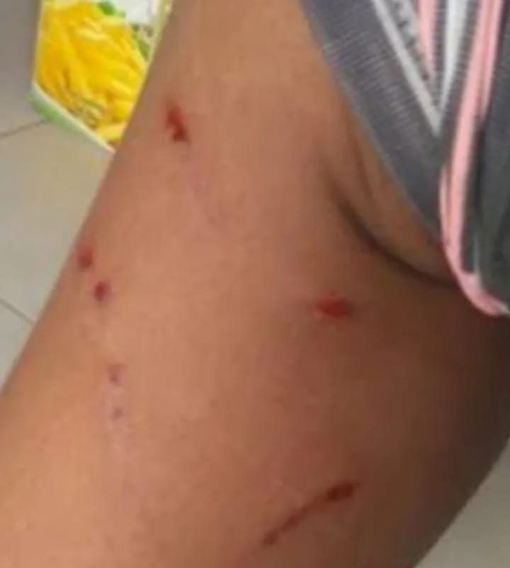 Mais uma pessoa é atacada por cachorro na Cidade Nova, em Lagarto