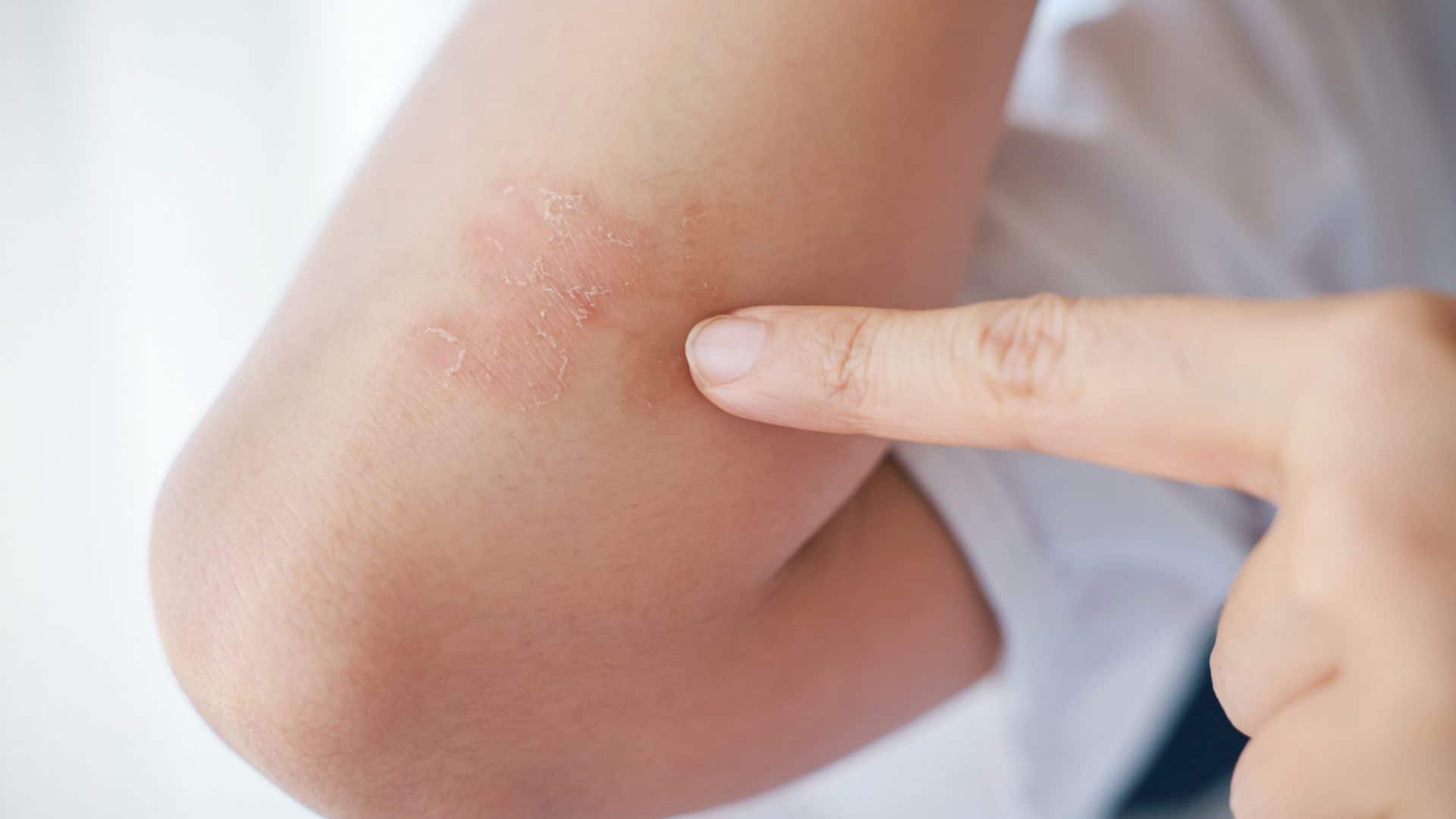 psoriasis-1-1920x1080