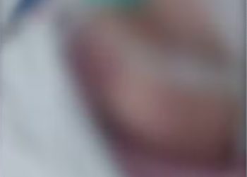 Exames apontam que objeto foi deixado dentro de pulmão de bebê de 3 meses durante processo de intubação em Sergipe