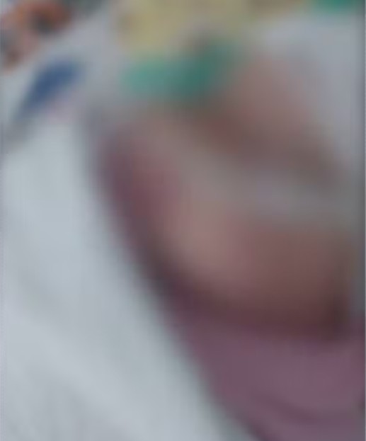 Exames apontam que objeto foi deixado dentro de pulmão de bebê de 3 meses durante processo de intubação em Sergipe