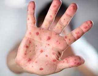 Por que milhões de pessoas em todo mundo vão contrair sarampo em 2026